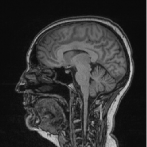 Cerebral abscess from pulmonary arteriovenous malformation (Radiopaedia 86275-102291 Sagittal T1 55).png