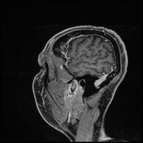 Cerebral abscess with ventriculitis (Radiopaedia 78965-91878 Sagittal T1 C+ 154).jpg