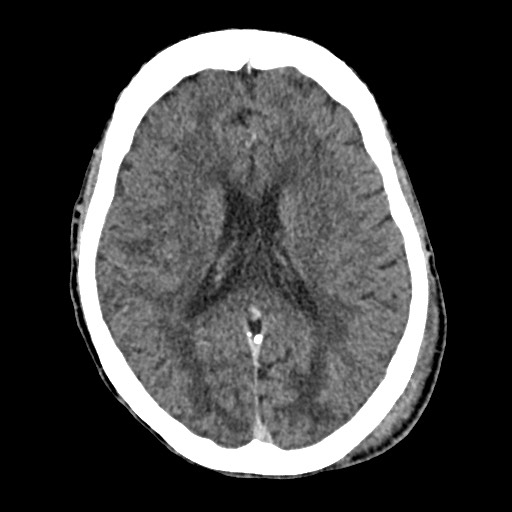 Cerebral amyloid angiopathy-related inflammation (Radiopaedia 74836-85848 Axial non-contrast 37).jpg