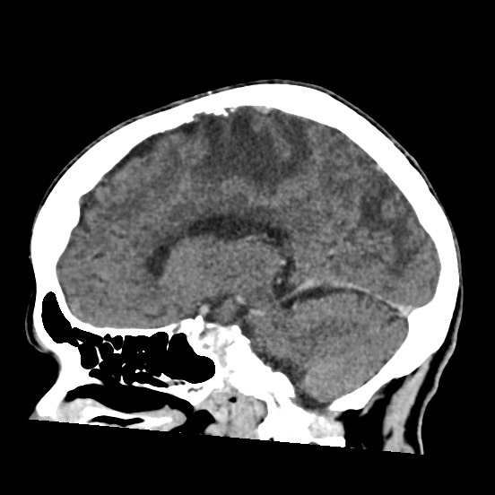 Cerebral amyloid angiopathy-related inflammation (Radiopaedia 74836-85848 C 26).jpg
