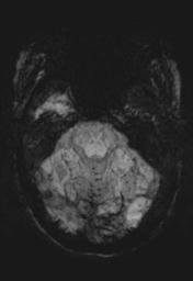 File:Cerebral amyloid angiopathy (Radiopaedia 29129-29518 Axial SWI MIP 8).jpg