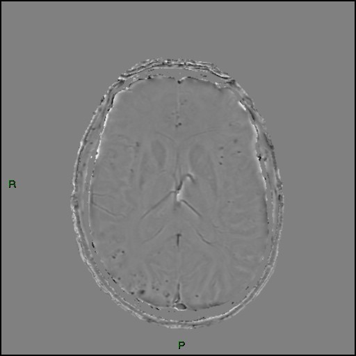 Cerebral amyloid angiopathy (Radiopaedia 77506-89664 H 59).jpg