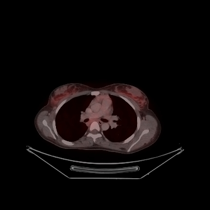 Cerebral and abdominal tuberculosis (Radiopaedia 90499-107853 C 97).jpg