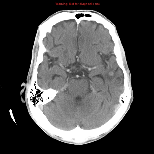 File:Cerebral and orbital tuberculomas (Radiopaedia 13308-13310 B 11).jpg