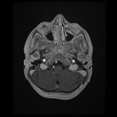 File:Cerebral and spinal tuberculosis (Radiopaedia 90489-107837 Axial T1 C+ 47).jpg