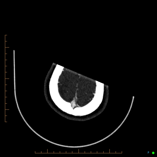 Cerebral arteriovenous malformation (AVM) (Radiopaedia 78162-90706 Axial CTA 245).jpg