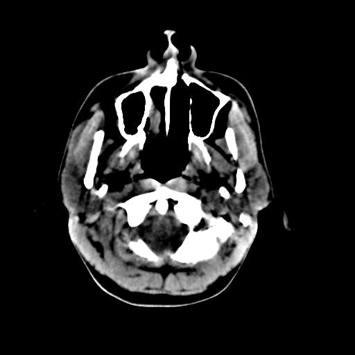 Cerebral arteriovenous malformation (Radiopaedia 28518-28759 Axial non-contrast 3).jpg