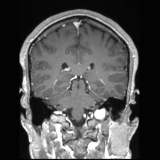 Cerebral arteriovenous malformation (Radiopaedia 39259-41506 Coronal T1 C+ 39).png