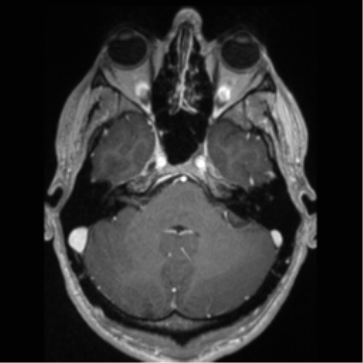 File:Cerebral arteriovenous malformation (Radiopaedia 55798-62372 Axial T1 C+ 18).png