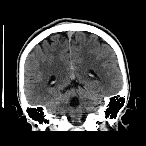 Cerebral arteriovenous malformation (Radiopaedia 61964-70028 Coronal non-contrast 41).jpg