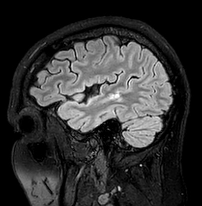Cerebral arteriovenous malformation (Radiopaedia 74411-85746 Sagittal FLAIR 20).jpg