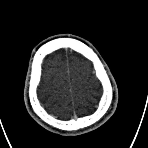 Cerebral arteriovenous malformation (Radiopaedia 78188-90746 Axial C+ delayed 149).jpg