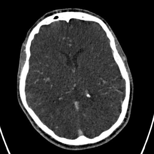 Cerebral arteriovenous malformation (Radiopaedia 78188-90746 Axial C+ delayed 95).jpg