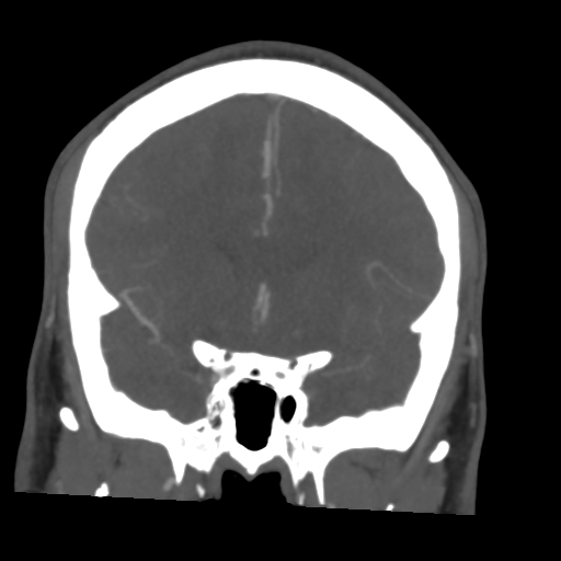 File:Cerebral arteriovenous malformation (Spetzler-Martin grade 2) (Radiopaedia 41262-44076 F 23).png