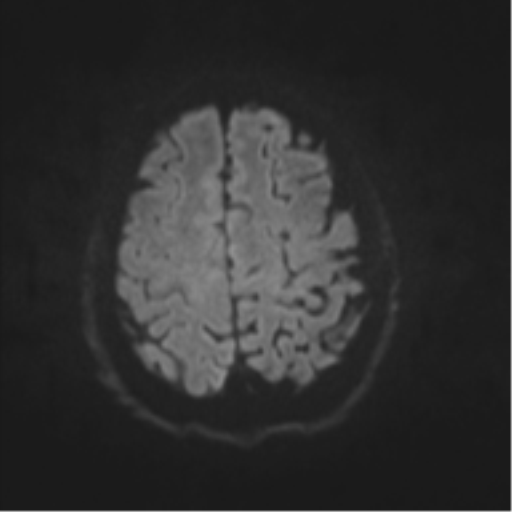 File:Cerebral arteriovenous malformation - huge (Radiopaedia 35734-37272 Axial DWI 42).png