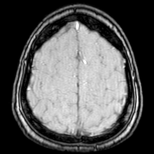 Cerebral arteriovenous malformation at posterior body of corpus callosum (Radiopaedia 74111-84925 Axial MRA 188).jpg