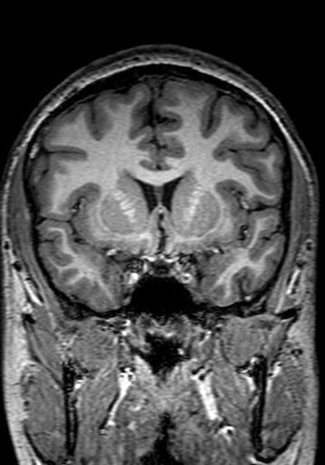Cerebral arteriovenous malformation at posterior body of corpus callosum (Radiopaedia 74111-84925 Coronal T1 118).jpg