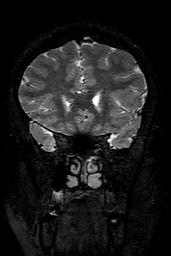 Cerebral arteriovenous malformation at posterior body of corpus callosum (Radiopaedia 74111-84925 Coronal T2 50).jpg