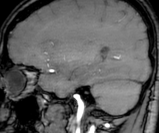 Cerebral arteriovenous malformation at posterior body of corpus callosum (Radiopaedia 74111-84925 J 105).jpg