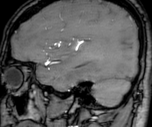 Cerebral arteriovenous malformation at posterior body of corpus callosum (Radiopaedia 74111-84925 J 81).jpg
