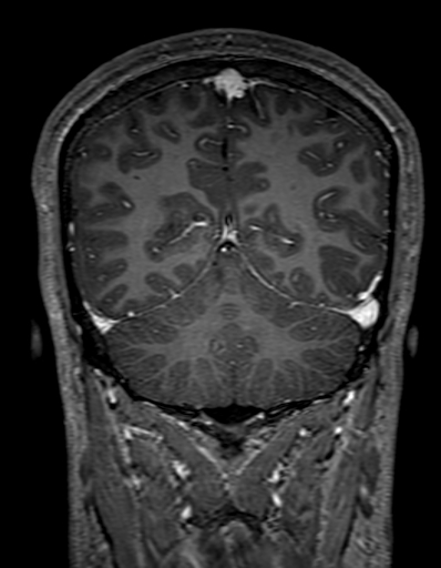 Cerebral arteriovenous malformation at posterior body of corpus callosum (Radiopaedia 74111-84925 K 277).jpg
