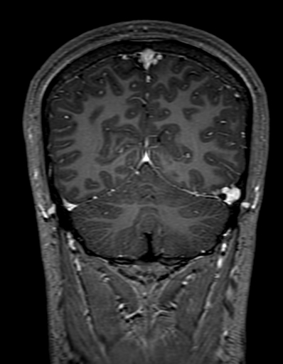Cerebral arteriovenous malformation at posterior body of corpus callosum (Radiopaedia 74111-84925 K 290).jpg