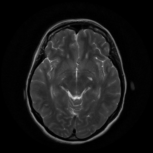 File:Cerebral autosomal dominant arteriopathy with subcortical infarcts and leukoencephalopathy (CADASIL) (Radiopaedia 41018-43768 Ax T2 PROP 9).png