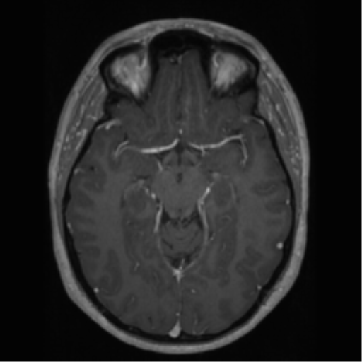 Cerebral cavernoma and development venous anomaly (Radiopaedia 37603-39482 Axial T1 C+ 32).png