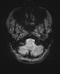 File:Cerebral cavernous venous malformation (Radiopaedia 70008-80021 I 5).jpg