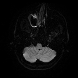 Cerebral cavernous venous malformation (Zabramski type II) (Radiopaedia 85511-101198 Axial DWI 7).jpg