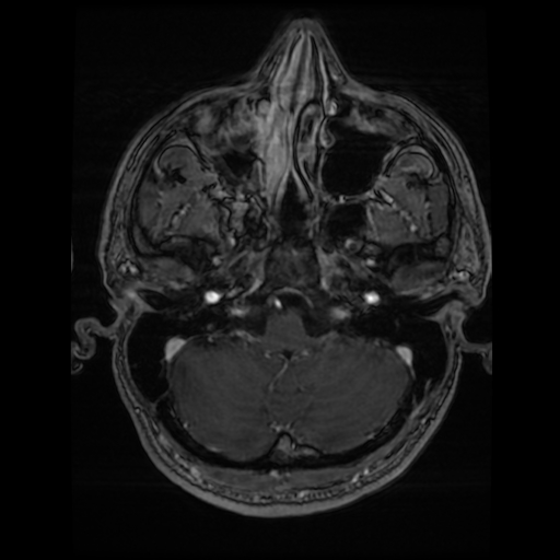 Cerebral cavernous venous malformation (Zabramski type II) (Radiopaedia 85511-101198 Axial T1 C+ fat sat 68).jpg