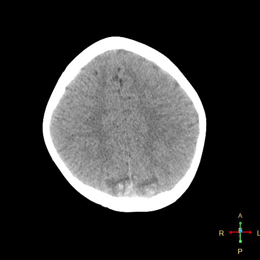 File:Cerebral contusion (Radiopaedia 48869-53911 Axial non-contrast 14).jpg
