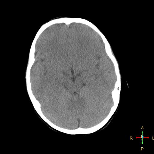 File:Cerebral contusion (Radiopaedia 48869-53911 Axial non-contrast 7).jpg