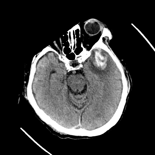 File:Cerebral contusions, subarachnoid hemorrhage and subdural hygromas (Radiopaedia 55399-61829 Axial non-contrast 21).png
