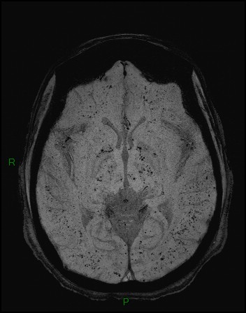 Cerebral fat embolism (Radiopaedia 35022-36525 Axial SWI 14).jpg