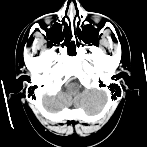Cerebral hemorrhage secondary to arteriovenous malformation (Radiopaedia 33497-34561 B 10).png