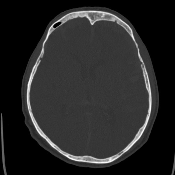 Cerebral hemorrhagic contusions (Radiopaedia 23145-23188 Axial bone window 30).jpg
