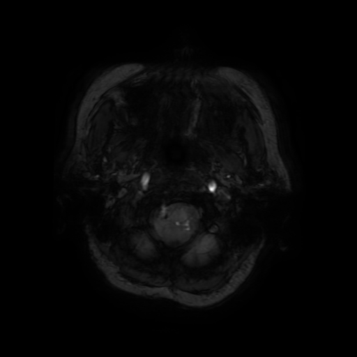 Cerebral metastases - melanoma (Radiopaedia 80972-94522 Axial SWI 8).jpg