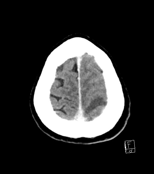 Cerebral metastases - testicular choriocarcinoma (Radiopaedia 84486-99855 Axial C+ delayed 10).jpg