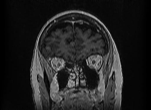Cerebral metastases from lung cancer with amyloid angiopathy and cerebellopontine angle meningioma (Radiopaedia 74306-85191 Coronal T1 C+ 11).jpg