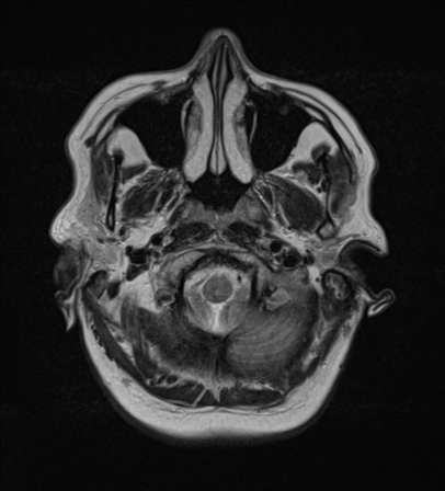 File:Cerebral metastases mimicking abscesses (Radiopaedia 45841-50131 Axial T2 4).png
