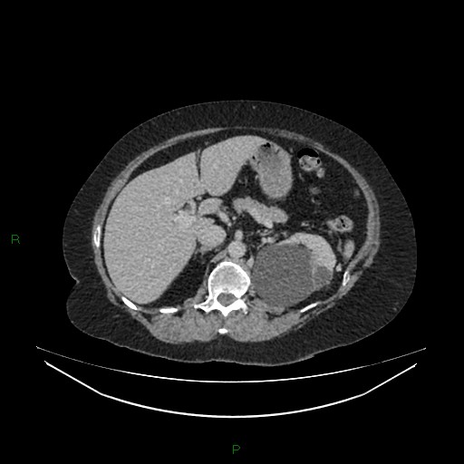 Cerebral metastasis from renal cell carcinoma (Radiopaedia 82306-96378 A 54).jpg