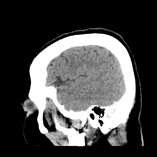 File:Cerebral metastasis to basal ganglia (Radiopaedia 81568-95412 Sagittal C+ delayed 46).png