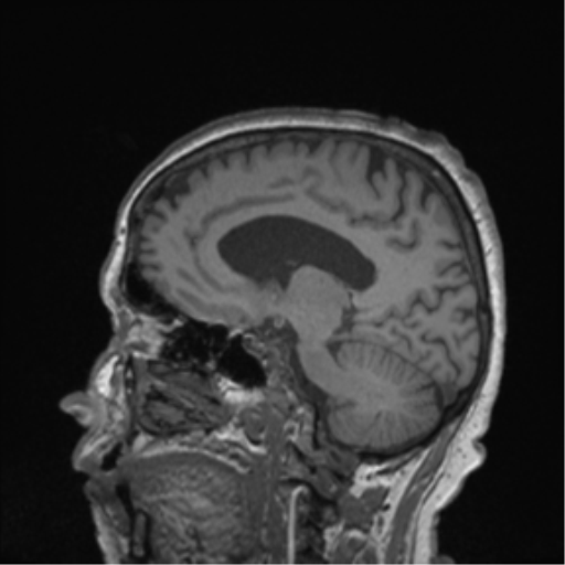 Cerebral metastasis to basal ganglia (Radiopaedia 81568-95413 Sagittal T1 30).png