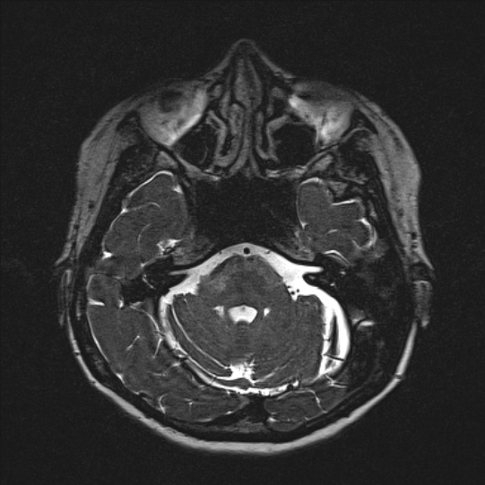 Cerebral ring enhancing lesions - cerebral metastases (Radiopaedia 44922-48817 F 42).jpg