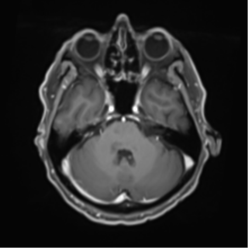 Cerebral toxoplasmosis (Radiopaedia 54575-60804 Axial T1 C+ 17).png