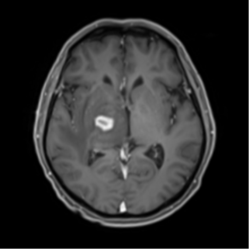 Cerebral toxoplasmosis (Radiopaedia 54575-60804 Axial T1 C+ 28).png