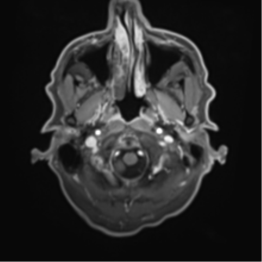 Cerebral toxoplasmosis (Radiopaedia 54575-60804 Axial T1 C+ 8).png