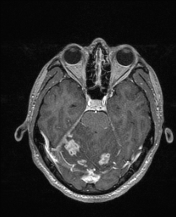 Cerebral toxoplasmosis (Radiopaedia 85779-101597 Axial T1 C+ 55).jpg