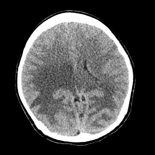 File:Cerebral tuberculosis with dural sinus invasion (Radiopaedia 60353-68018 Axial non-contrast 34).jpg